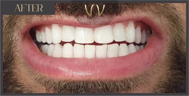 After treatment: edges rebuilt and evened