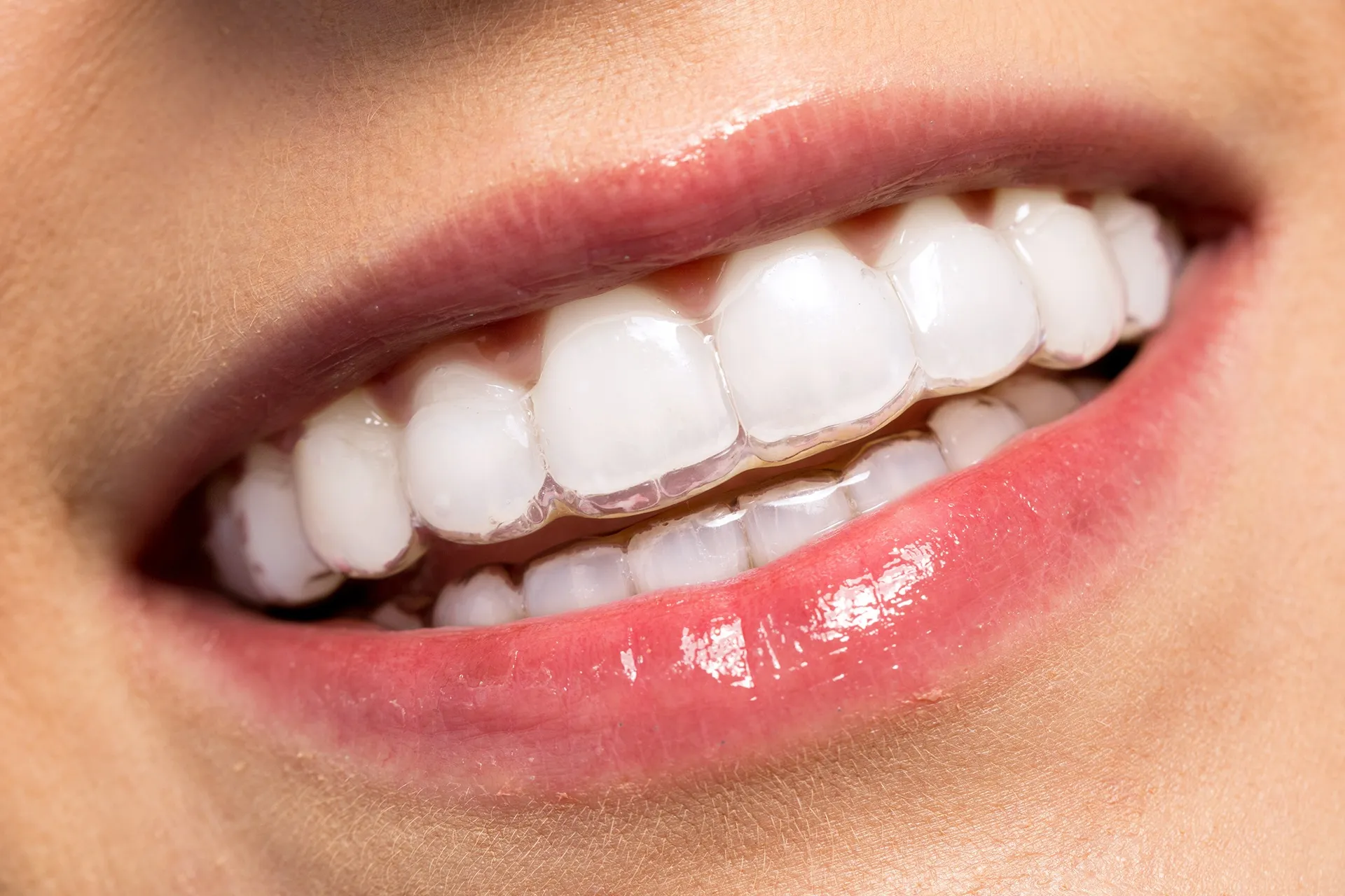 Invisalign clear braces at the practice